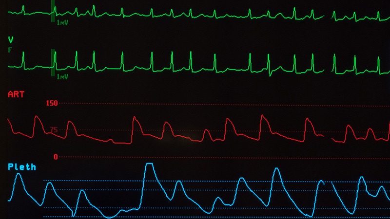 AF Linked to Severe AEs After UACDT for Thrombolysis