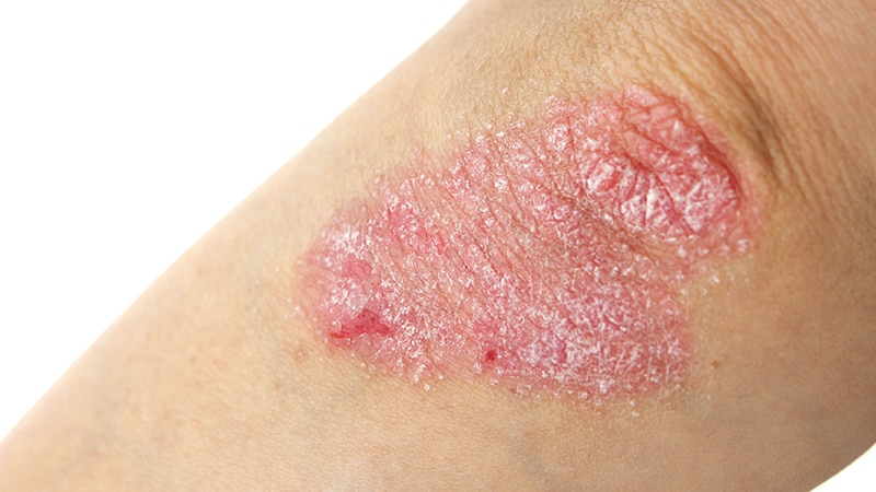 Cardiac Risks With Newer Psoriasis Meds Match TNF Inhibitors