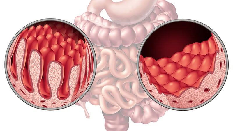 Sequential CE-DBE Approach Detects CD-Related Complications