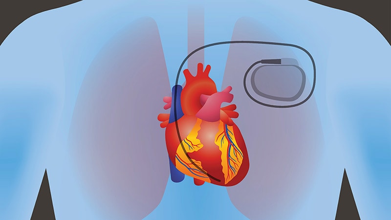 Soaring Pacemaker Demand Spurs Controversial New Approach