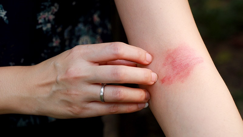 Nemolizumab Gets FDA Nod for Atopic Dermatitis