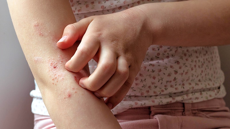 Childhood Atopic Dermatitis Doesn't Delay Puberty