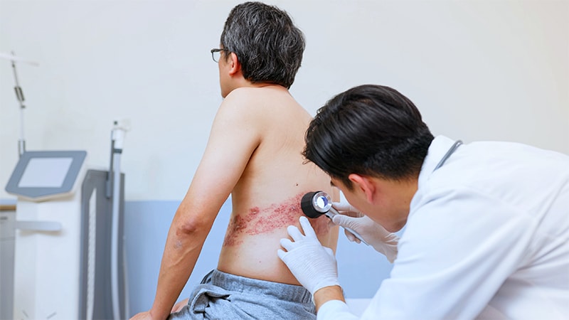 Higher Risk for Herpes Zoster Complications With IBD