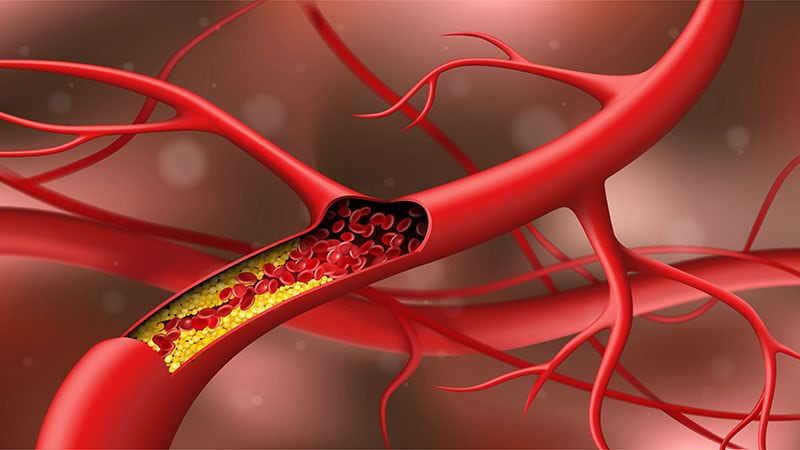 Lupus Ups Atherosclerosis Risk, But Disease Remission Helps