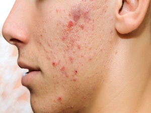 What's New in Acne Treatment?