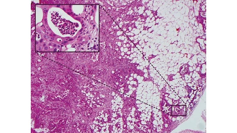 KRAS Mutation Types Shape Pancreatic Cancer Outcomes